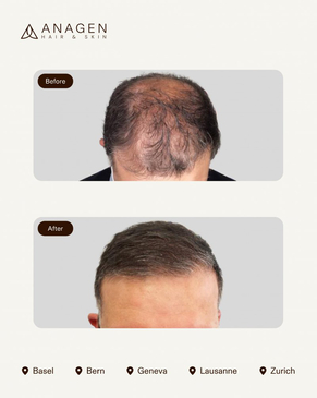 Slider image (8) Anagen - Hair Transplant Clinic in Switzerland